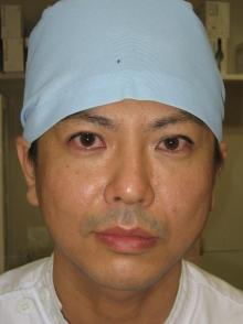 二重まぶたになりたい　医師の埋没法体験記　その4