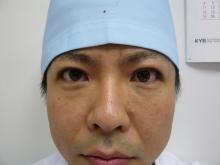 二重まぶたになりたい　医師の埋没法体験記　その7