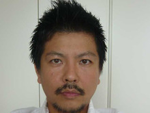 埋没法体験記　その12術後1か月半くらい