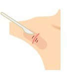 ワキガの手術ってどんなものでしょう？剪除法・切開法・反転法