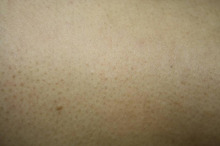 二の腕のぶつぶつ 毛孔性苔癬・毛孔性角化症