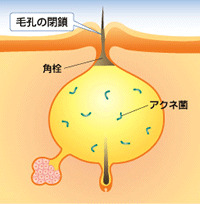 【ニキビ】自分で面皰圧出　その２