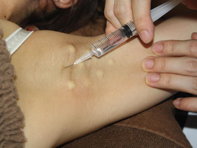 ワキのBOTOX（多汗症に効果）