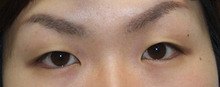 【画像】二重手術（埋没法）直後～１週間後