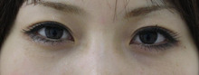 【画像】平行型二重手術（埋没法）一週間後
