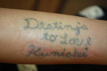 【画像】Ｔａｔｔｏｏ（入れ墨）レーザー除去