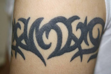 【画像】Ｔａｔｔｏｏ（入れ墨）切開除去