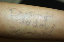 【画像】Ｔａｔｔｏｏ（入れ墨）レーザー除去 1回目2ヶ月後