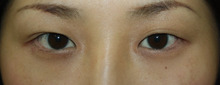 【画像】蒙古ヒダが強い人の平行型二重手術（埋没法のみ）