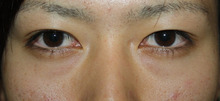【画像】男の腫れない埋没法　直後～10日後