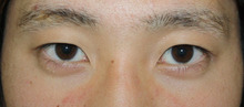 【画像】男の腫れない埋没法2（平行型二重・手術直後）