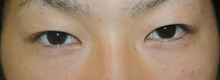 【画像】男の腫れない埋没法3（硬派な末広型手術直後～3日目）