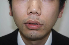 ヒゲの脱毛について（お肌つるつる・若返り効果も）1