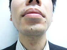 ヒゲの脱毛について（お肌つるつる・若返り効果も）3