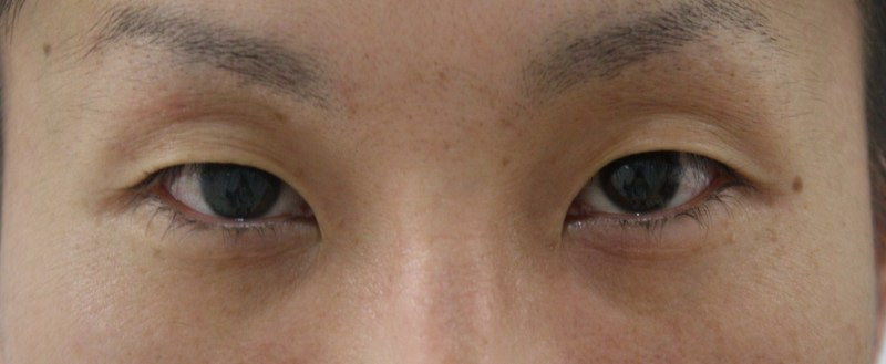 【画像】男の腫れない埋没法4（くぼみ目末広型手術直後～6日目）