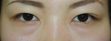 【プレミアムクイック】で腫れずに二重ライン安定(^O^)