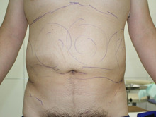 37歳男性の脂肪吸引（お腹まわり・他院修正）　1