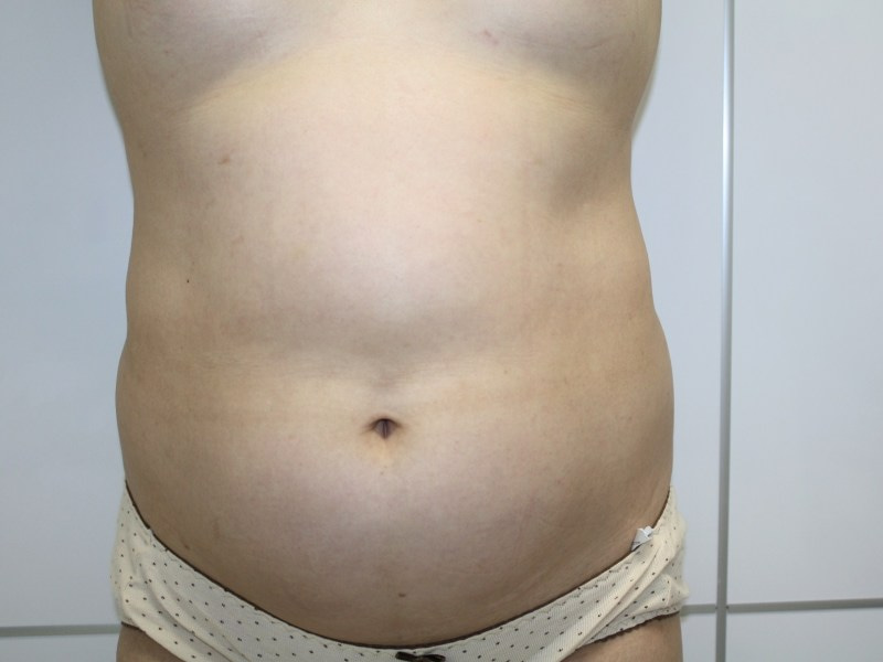【画像】160cm80kg女性の腹部脂肪吸引　その4（3ヶ月）