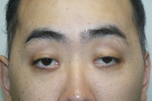 【画像】眼瞼下垂手術　挙筋前転術　39歳男性 3