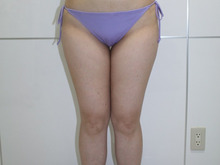 太もも・臀部・膝・上臀部の脂肪吸引 34歳女性2（1週間後）