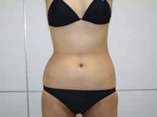 29歳女性　腹全体+腰+上臀部脂肪吸引　1