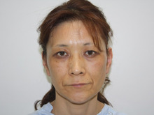 【手術直後】シンシアシグネチャーリフト 50歳女性　2