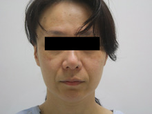 スリムリフトで顔の若返り　46歳女性　1
