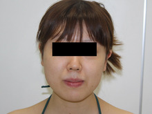 頬・アゴ脂肪吸引　26歳女性　その1（ダウンタイム中）