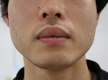 ★1　男の口唇縮小術 術前～1週間　1