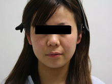 【大人顔美人】20歳女性　頬・アゴ脂肪吸引（術前～2ヶ月まで）