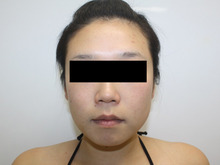 29歳女性 頬・アゴ脂肪吸引2【2ヵ月後】