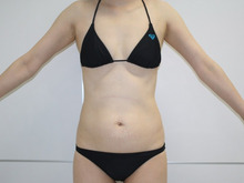 【44歳女性 たるみ＋】腹部・腰部上臀部脂肪吸引1　ダウンタイム中