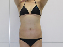 45歳女性 腹部・腰部・上臀部脂肪吸引1　（ダウンタイム中）