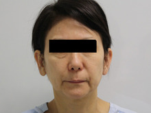 55歳女性フェイスリフト+頬アゴ脂肪吸引2【1ヵ月後】