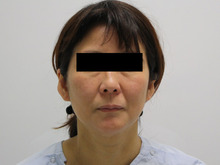46歳女性フェイスリフト+頬アゴ脂肪吸引+ほうれい線脂肪注入1【ダウンタイム】