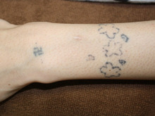 自分で墨汁で入れたTattooのレーザー除去3回後