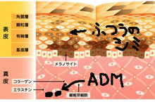 ライムライトで絶対に良くならないシミとは【ＡＤＭ 後天性真皮メラノサイトーシス】2
