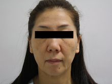 【51歳女性】フェイスリフトで39歳に見せる(｀・ω・´)1　ダウンタイム中