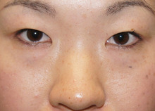 強い蒙古ひだ　レディエッセとセミプレミアムで立体感