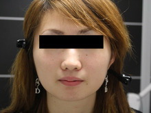 【20歳女性】頬・アゴ脂肪吸引（スリムリフト）　1　ダウンタイム中