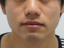 男だって小顔注射でよりすっきりとした男前になれる(*｀･ω･´)ゞ