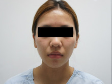 ２２歳女性　頬・アゴ脂肪吸引（スリムリフト）アゴレディエッセ1　ダウンタイム