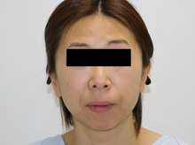 46歳タルミ軽度な患者様のフェイスリフト1【ダウンタイム】