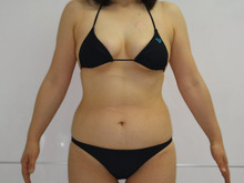 41歳女性　腹部・腰部・上臀部の脂肪吸引2（半年後）