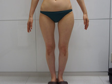 31歳女性　O脚の患者様の太もも・お尻・膝周り脂肪吸引1（ダウンタイム）
