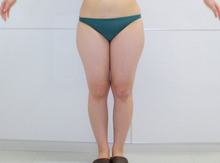 【半年】22歳太もも・お尻・膝回り　脂肪吸引　158㎝52㎏ 　2