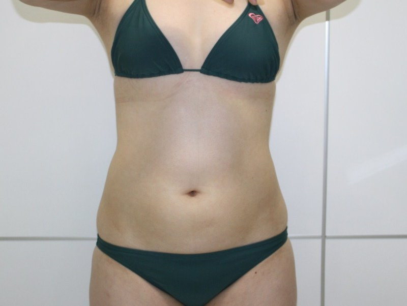 【ダウンタイム】お腹回り（腹部・腰部・上臀部） 　脂肪吸引　158㎝52㎏