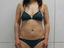 46歳女性159㎝61㎏腹部・腰部・上臀部スリムリフト　（ダウンタイム）