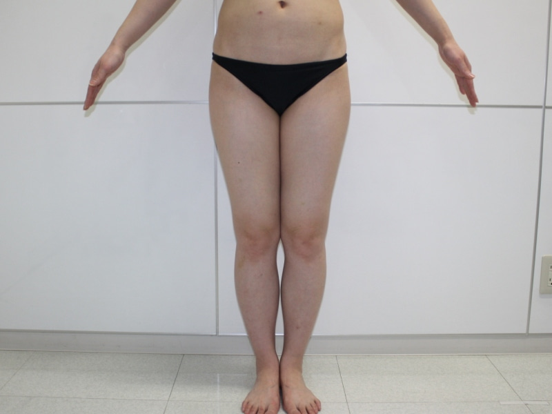 全身の脂肪吸引でキレイな体型に 30歳女性161㎝56㎏　2（太ももダウンタイム）