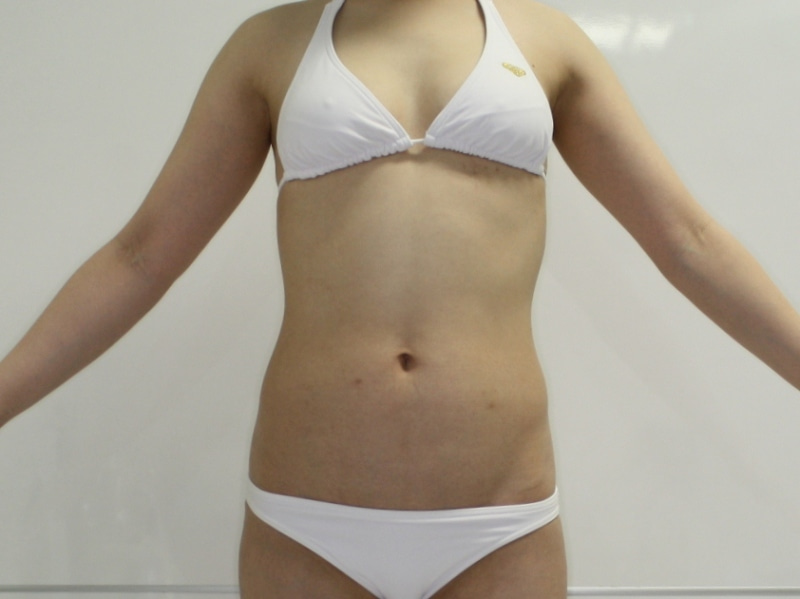 全身の脂肪吸引でキレイな体型に 30歳女性161㎝56㎏　5（お腹回り半年）